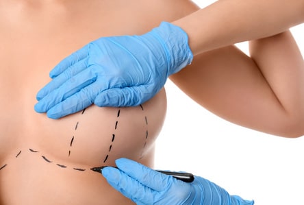 Breast implant removal scars