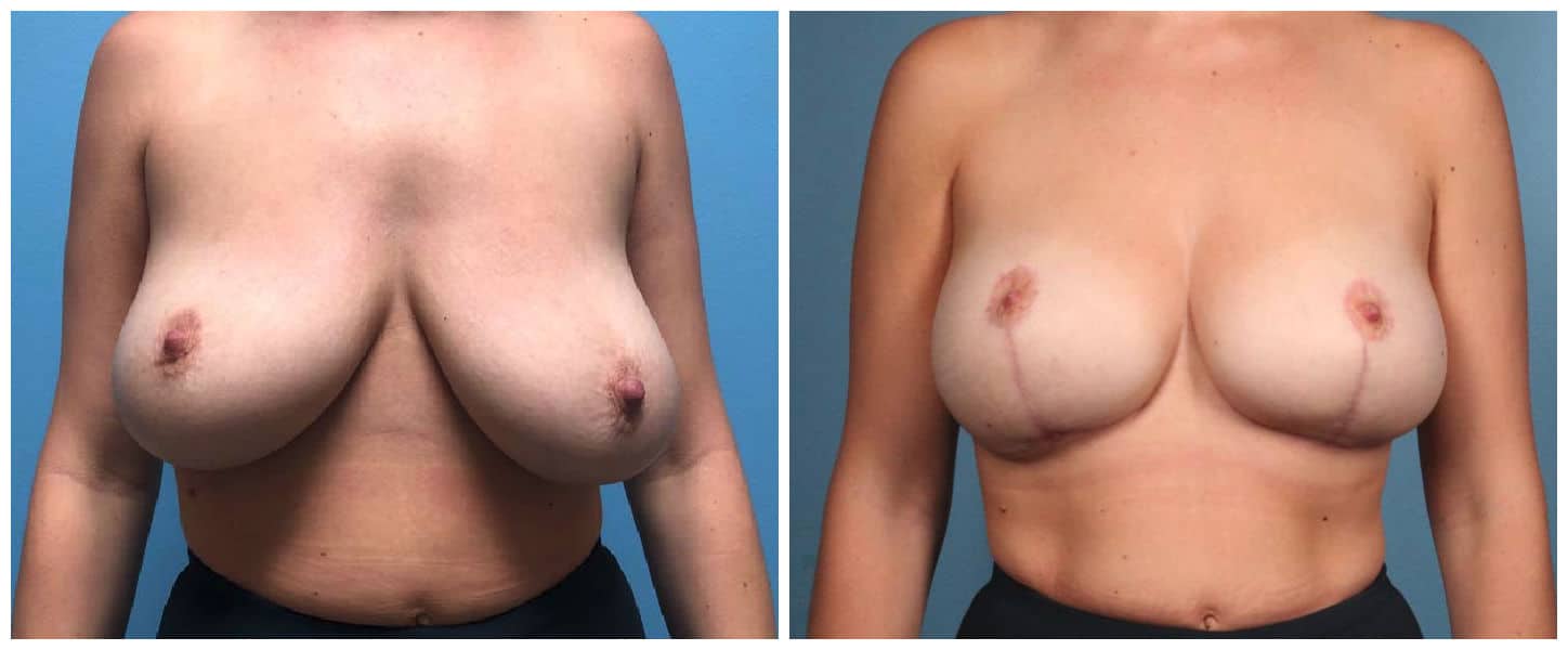 Breast lift Houston