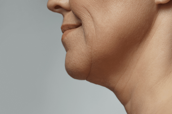 Celebrity Chin Liposuction Scar