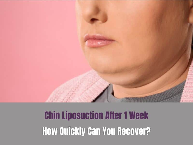 Chin Liposuction After 1 Week- How Quickly Can You Recover?