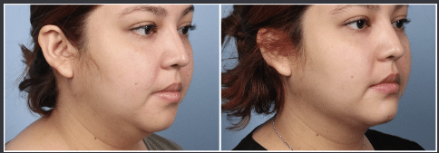 Chin Liposuction Houston