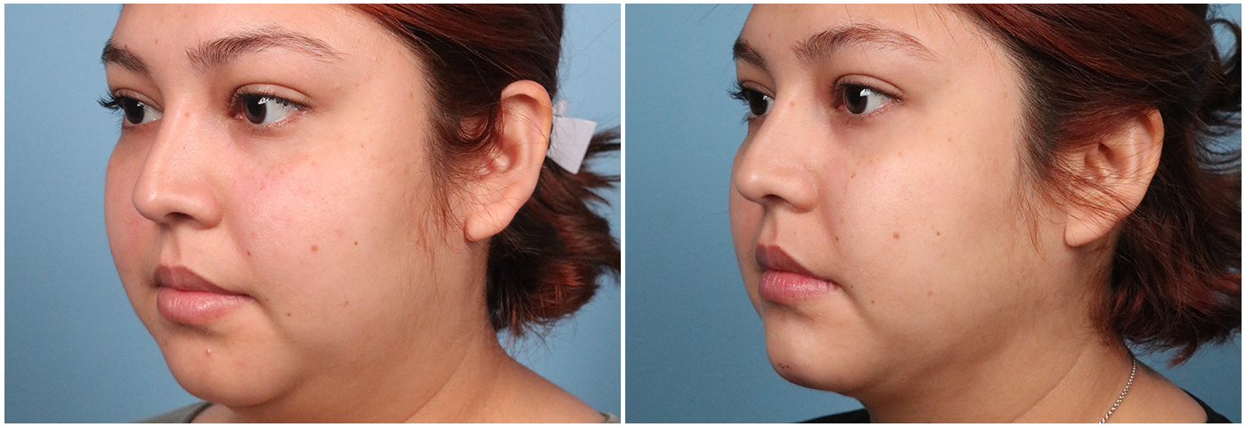 Chin Liposuction Cut and Shoot