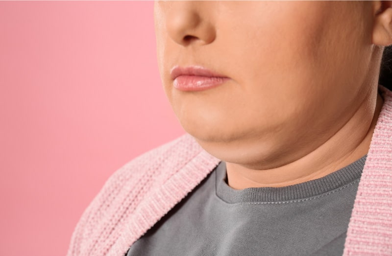 Chin lipo recovery