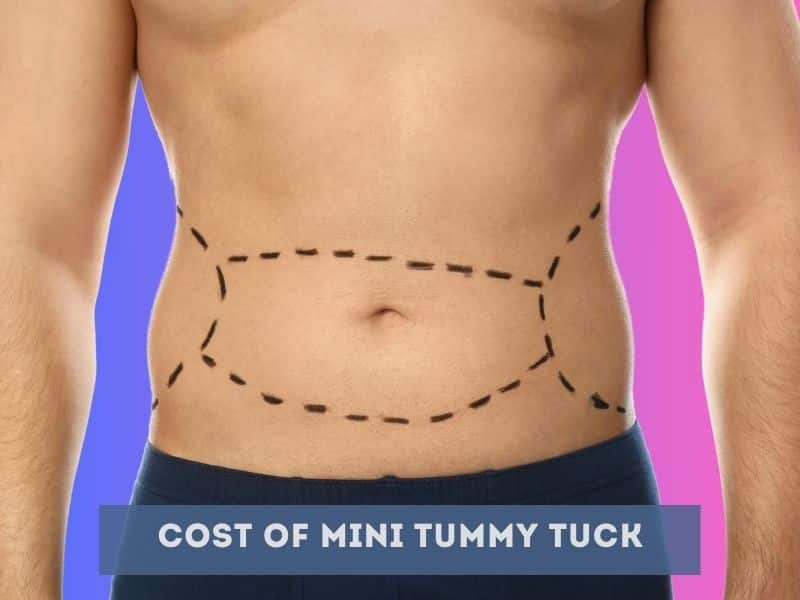 Cost Of Mini Tummy Tuck