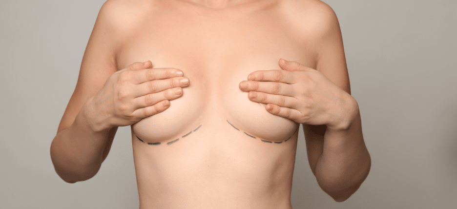 Does Insurance Cover Breast Implant Removal