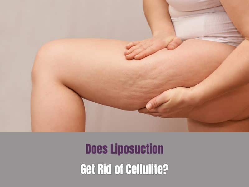 Does Liposuction Get Rid of Cellulite