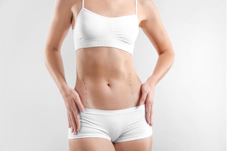 Does liposuction leave scars