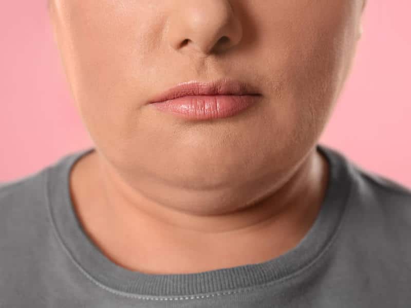 Double Chin Liposuction