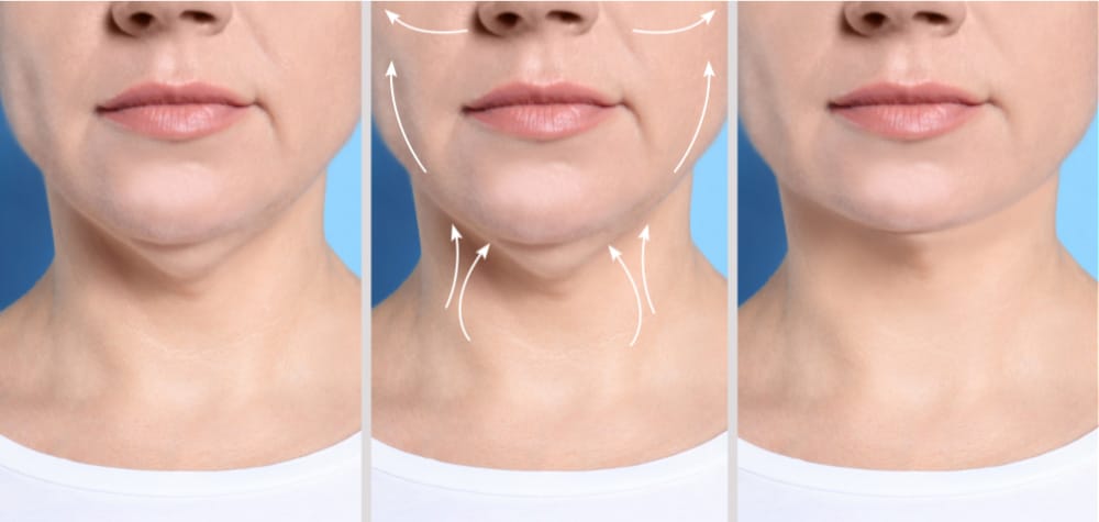 Double chin surgery