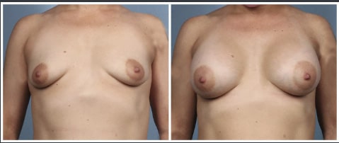 Fat transfer breast augmentation Houston