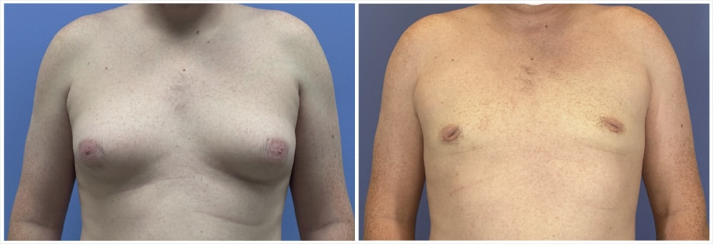 Gynecomastia Houston