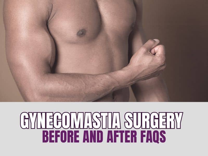 Gynecomastia Surgery Before and After FAQs