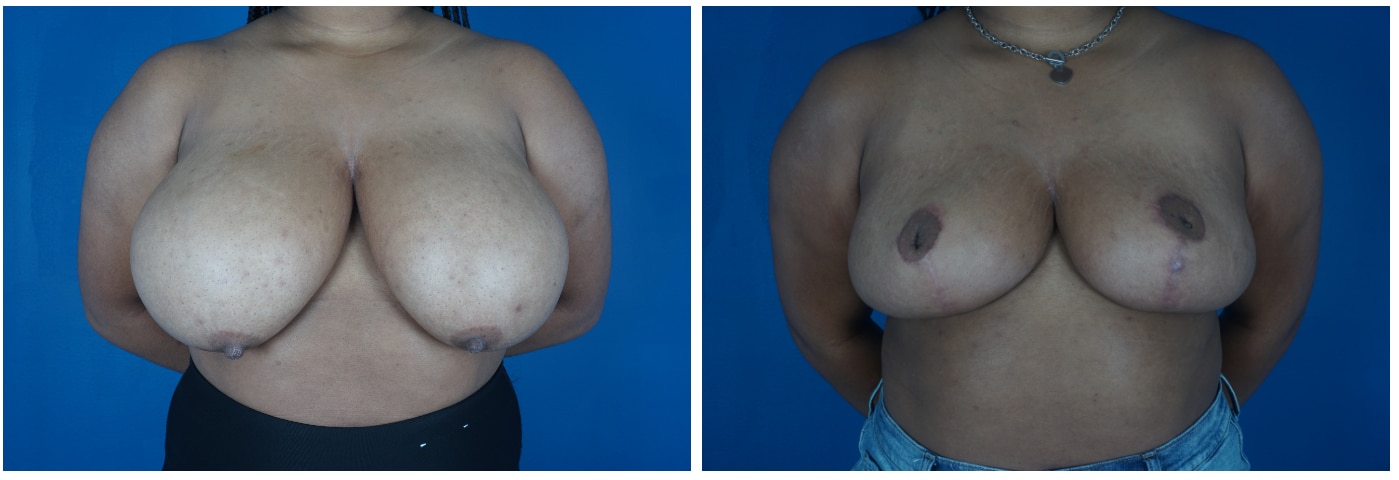 Houston Breast Reduction Patient 10 Anterior
