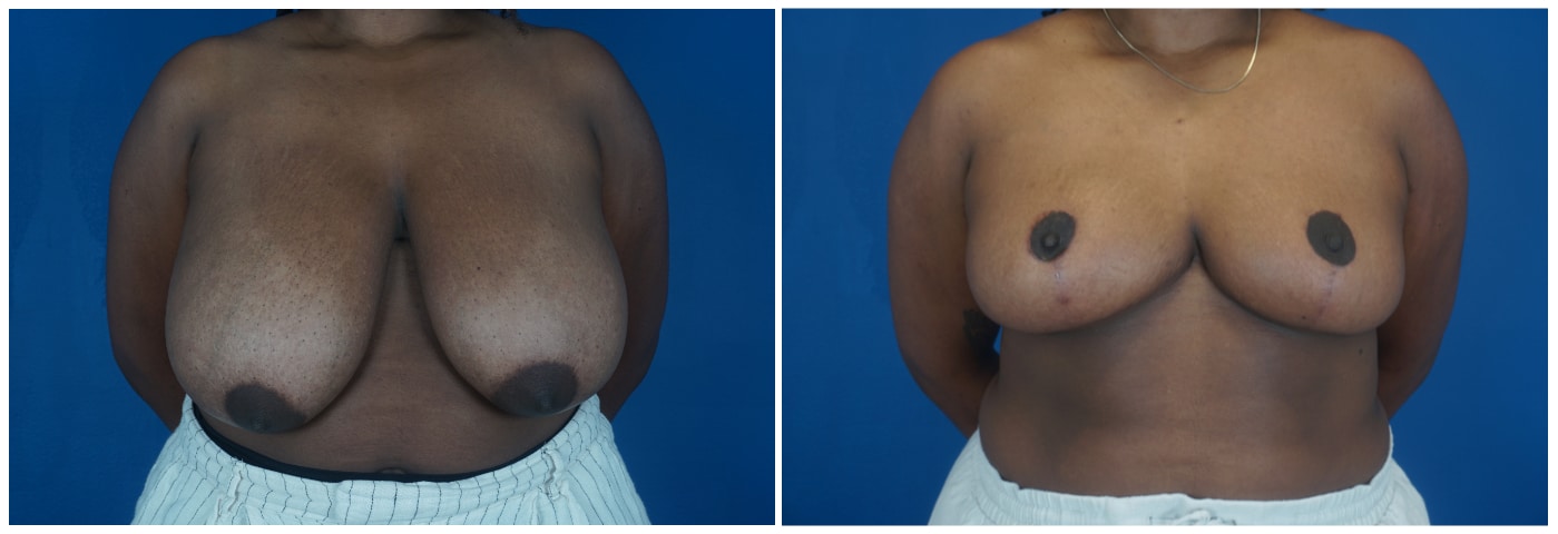Houston Breast Reduction Patient 11 Anterior
