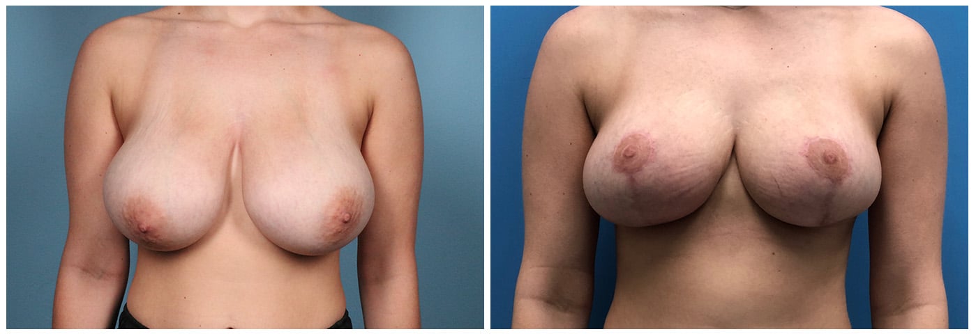 Houston breast Reduction