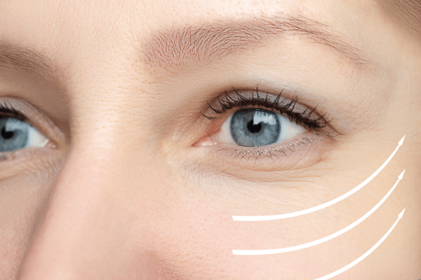 How To Qualify For Eyelid Surgery Medicare