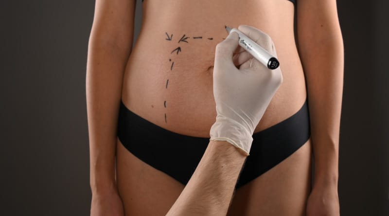 How safe is liposuction