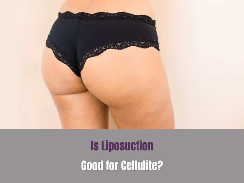 Is Liposuction Good for Cellulite
