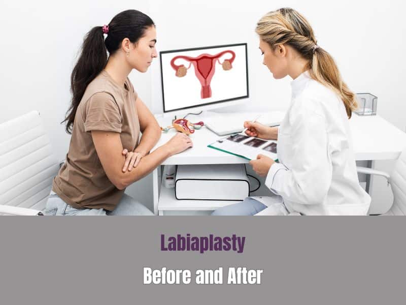 Labiaplasty Before and After
