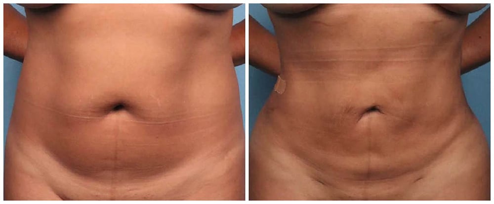 Lipo 360 Houston