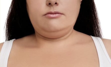 Liposuction In Neck And Chin
