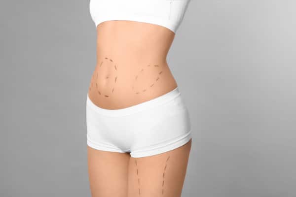 To-do List: How to Prepare for and Recover from Liposuction – Aristocrat  Plastic Surgery