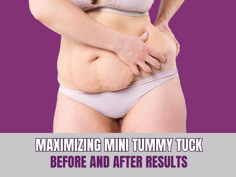 Maximizing Mini Tummy Tuck Before and After Results