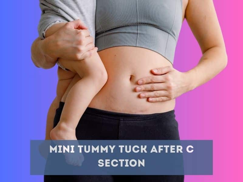 Mini Tummy Tuck After C Section