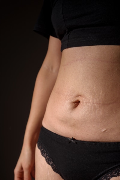 Mini Tummy Tuck Cost