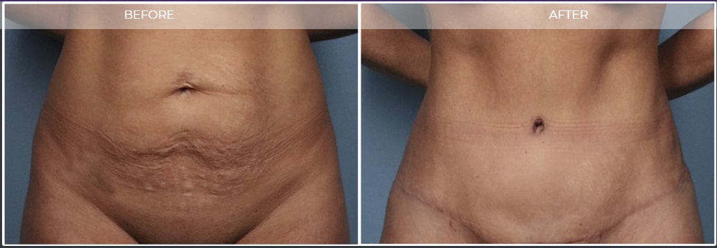 Mini Tummy Tuck Houston