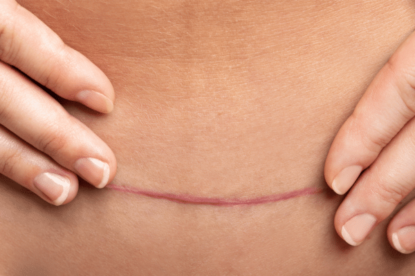 How to Hide a Mini Tummy Tuck Scar