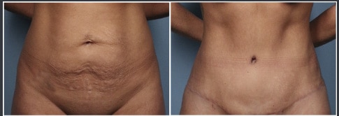 Mini tummy tuck recovery time