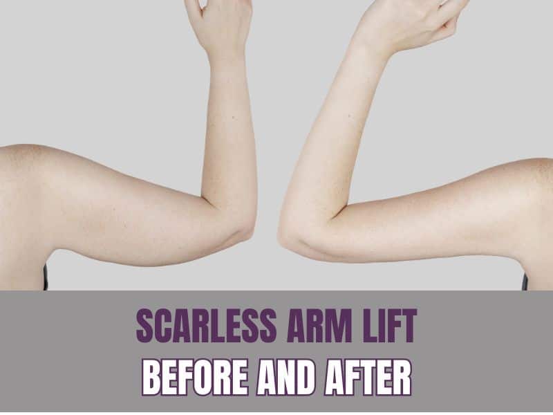 SCARLESS ARM LIFT BEFORE AND AFTER