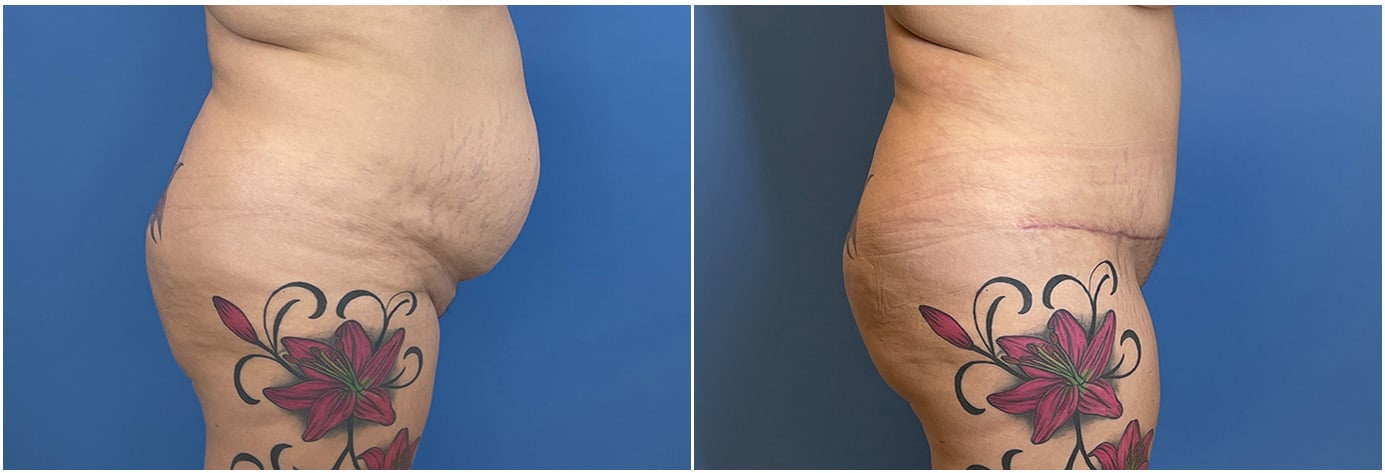 Tummy Tuck Patient 3 Right
