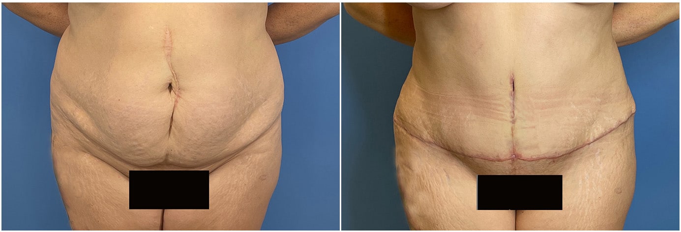 Tummy Tuck Patient 3 front