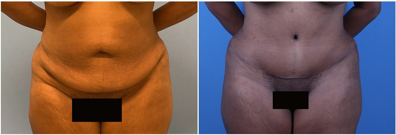 Tummy Tuck Patient 4 Front