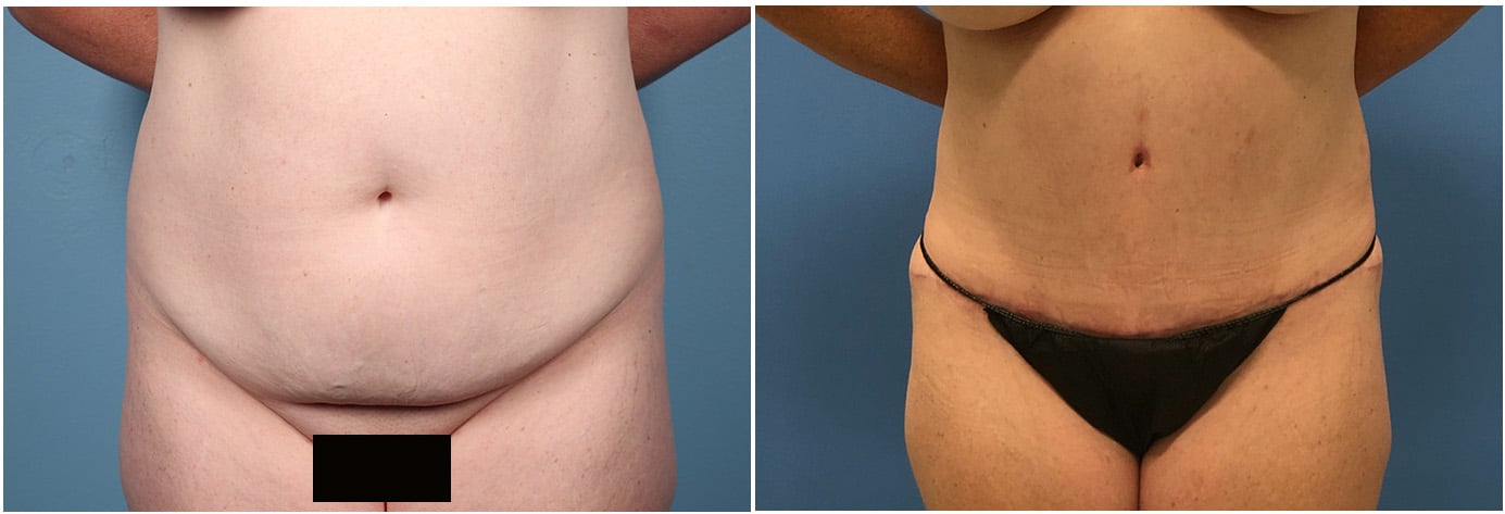 Tummy Tuck Patient 5 Front