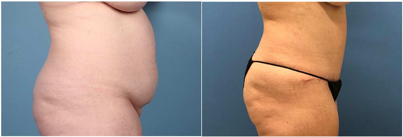 Tummy Tuck Patient 5 Right
