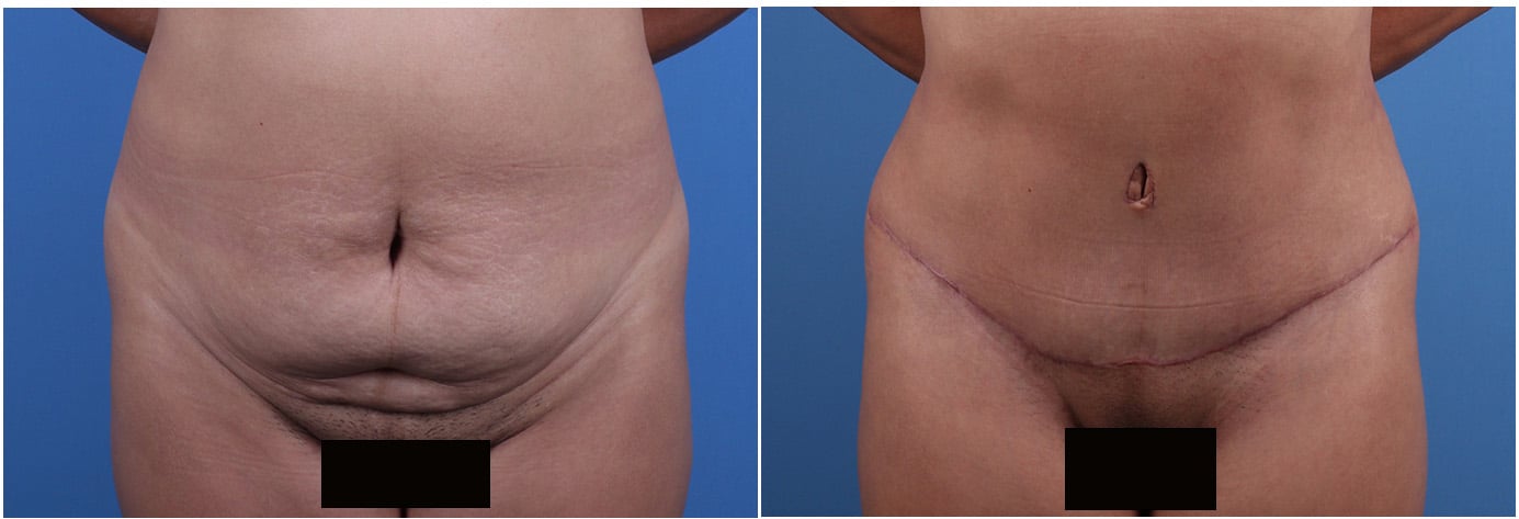 Tummy Tuck Patient 6 Front