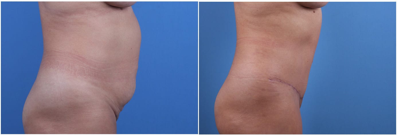 Tummy Tuck Patient 6 Right