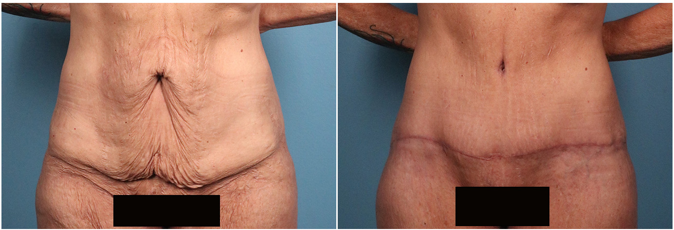 Tummy Tuck Fulshear