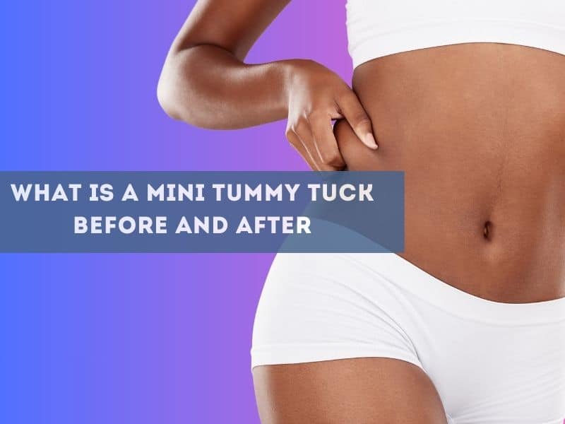 What Is A Mini Tummy Tuck Before And After