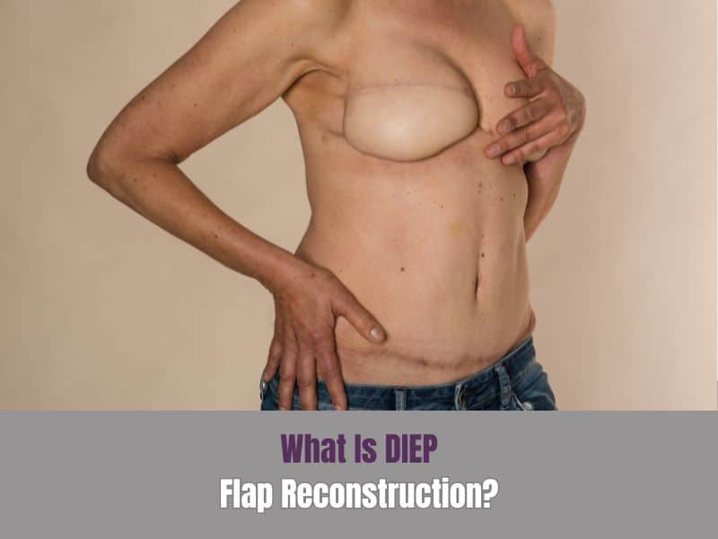 What Is DIEP Flap Reconstruction?