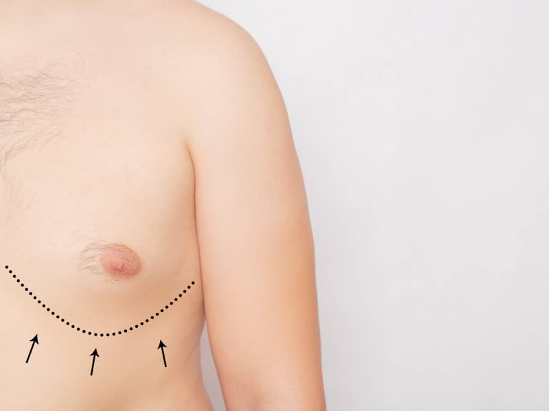 What You Need To Know About Gynecomastia Treatment
