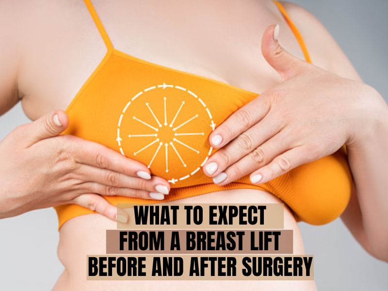 What to Expect From a Breast Lift Before and After Surgery