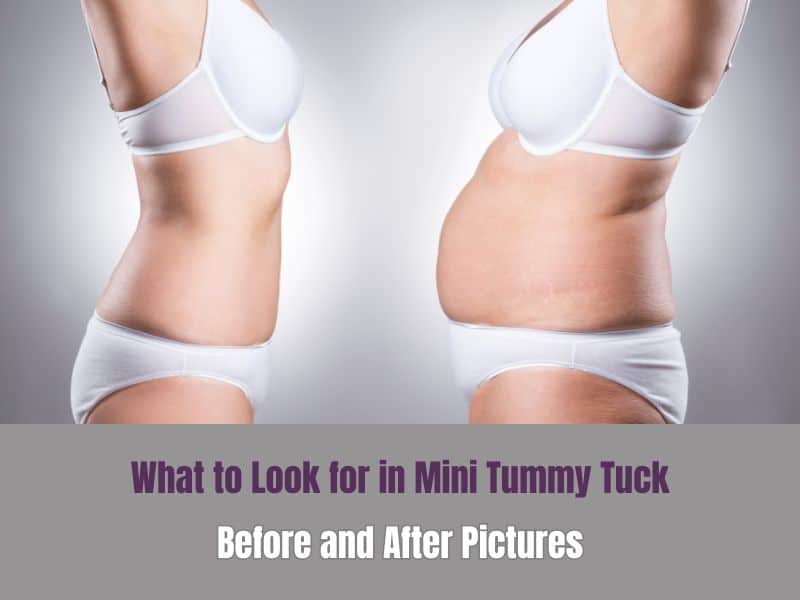 What to Look for in Mini Tummy Tuck Before and After Pictures