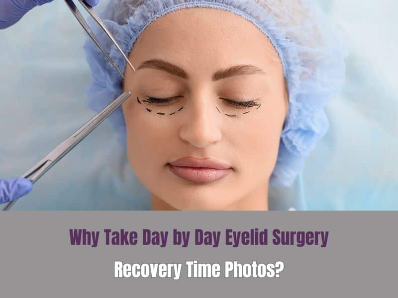 Why Take Day by Day Eyelid Surgery Recovery Time Photos