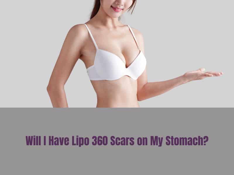 Will I Have Lipo 360 Scars on My Stomach