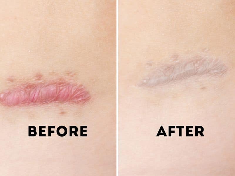 arm lift before and after scar arm lift before and after scar