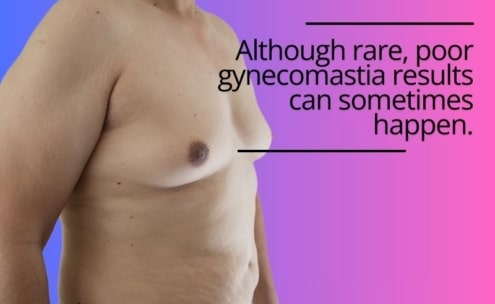 bad gynecomastia surgery before and after
